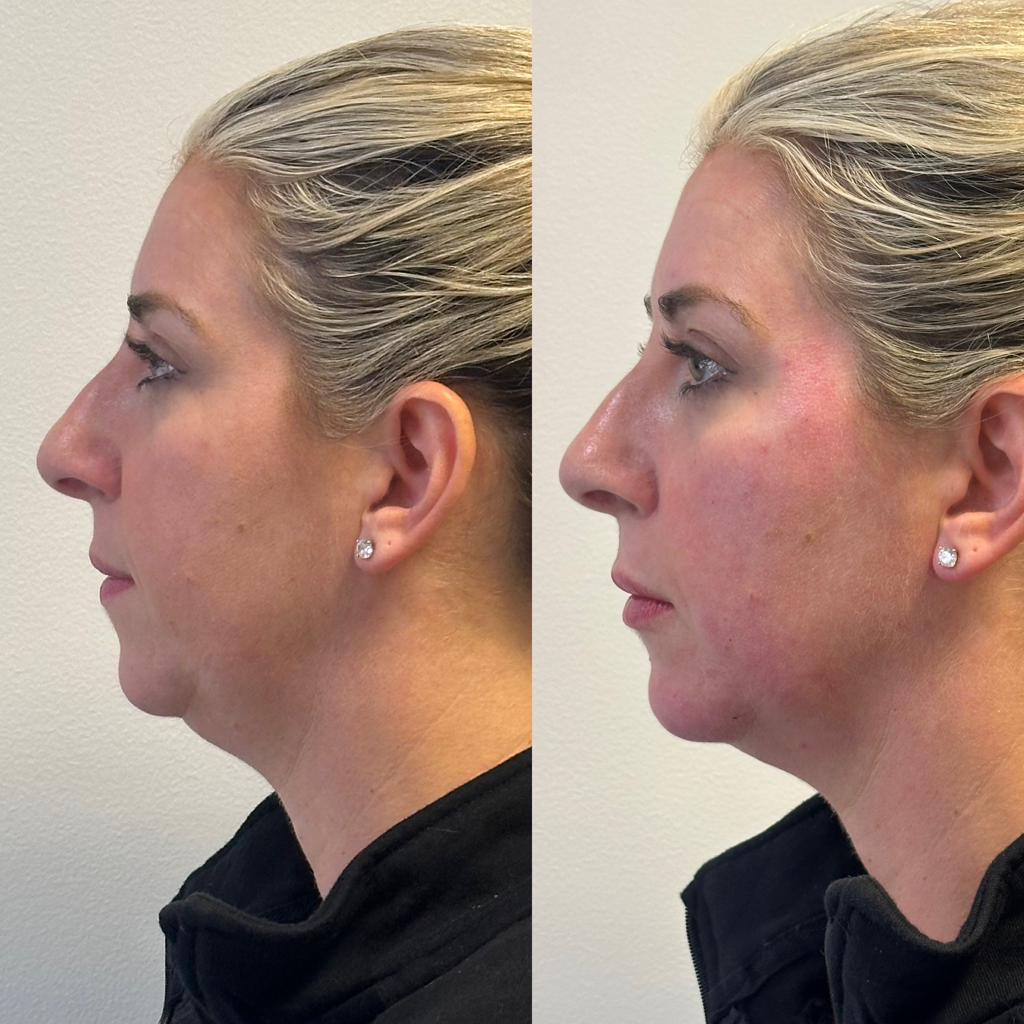 Before and After Image: Facial Balancing - left-side
