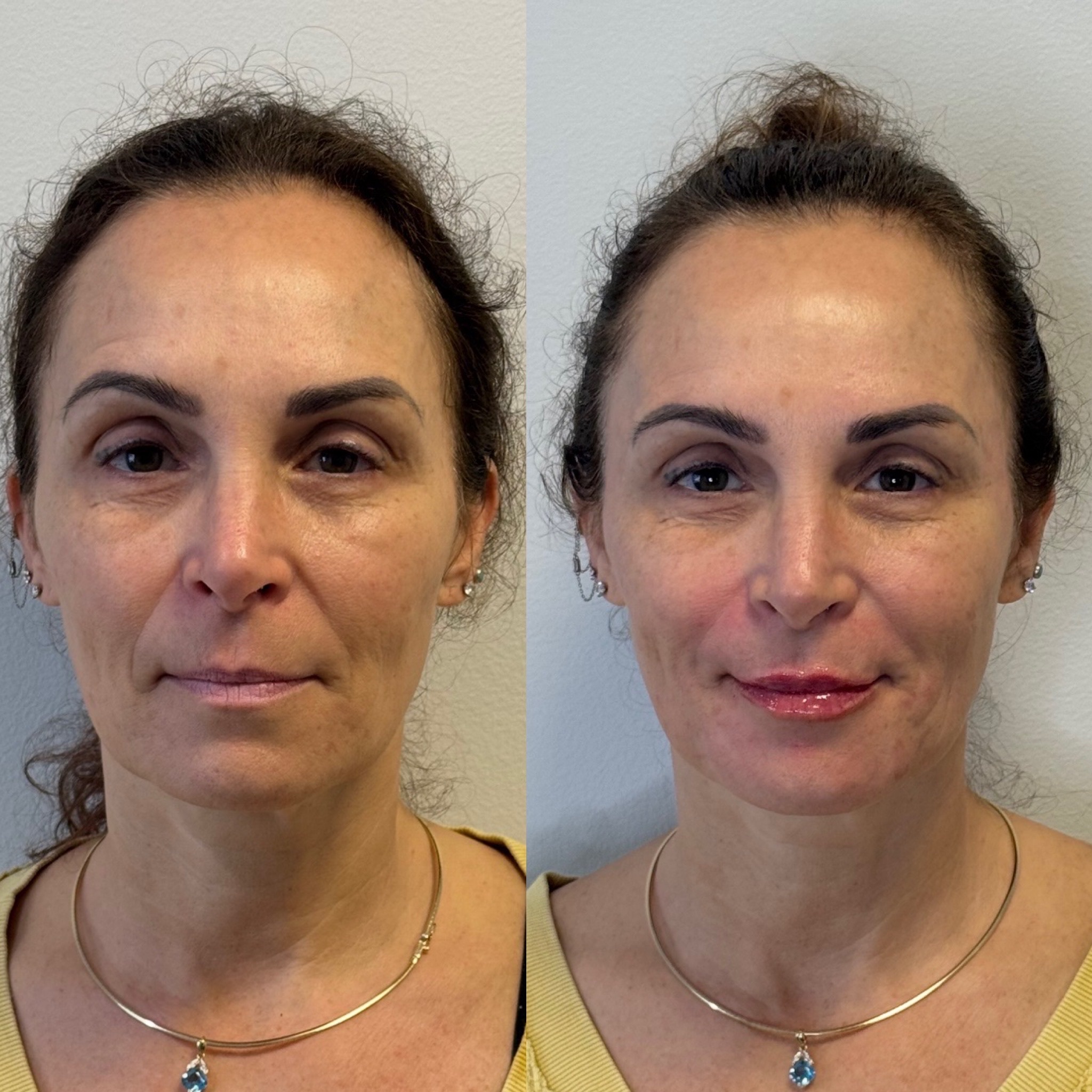 Before and After Image: Facial Balancing - front
