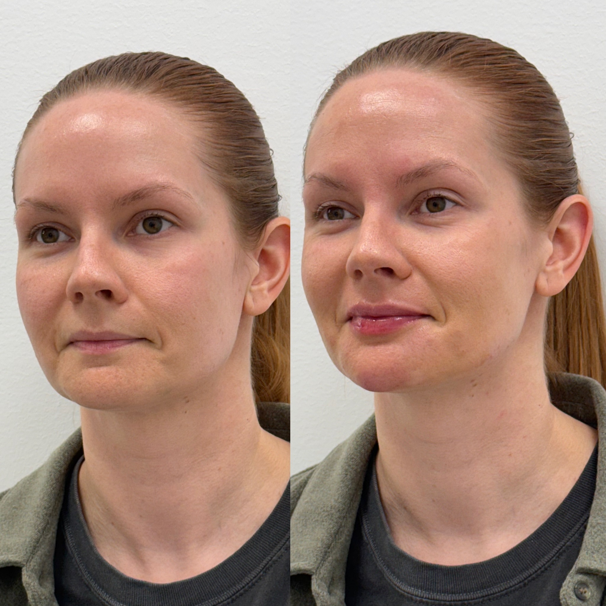 Before and After Image: Facial Balancing - left-front-oblique