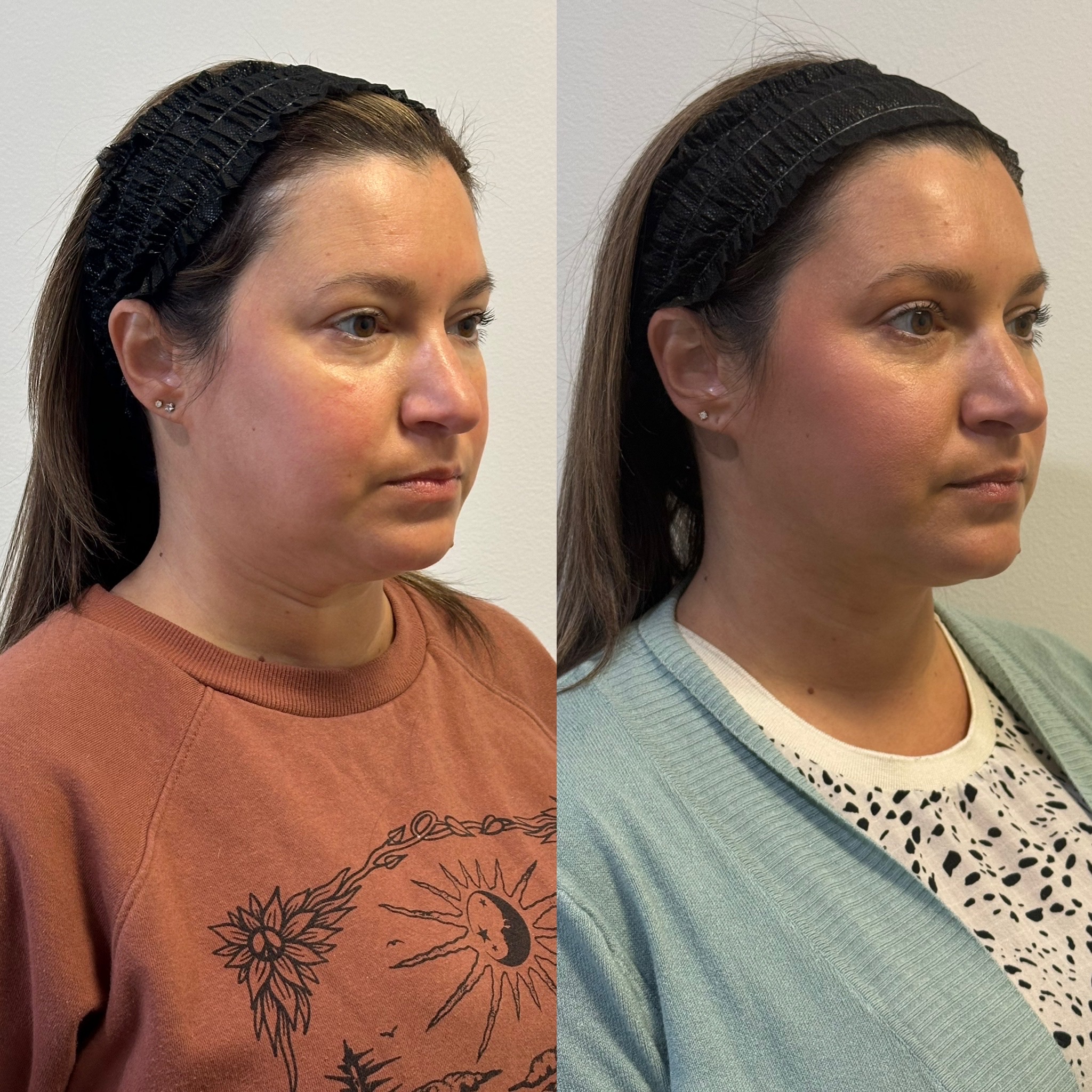 Before and After Image: Full Face Botox - right-front-oblique