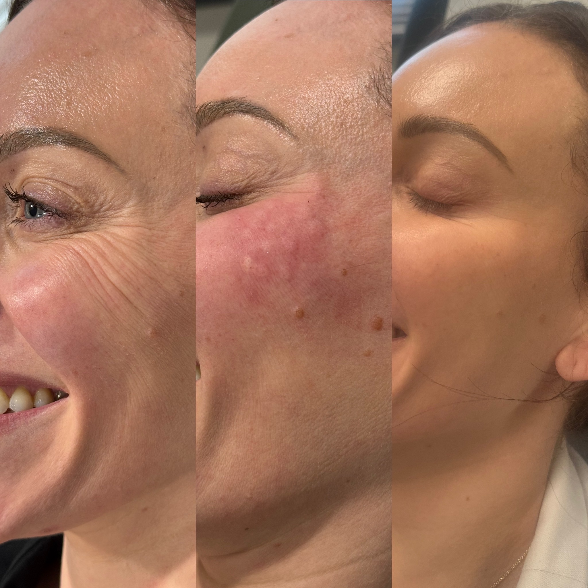 Before and After Image: Skinvive - left-front-oblique