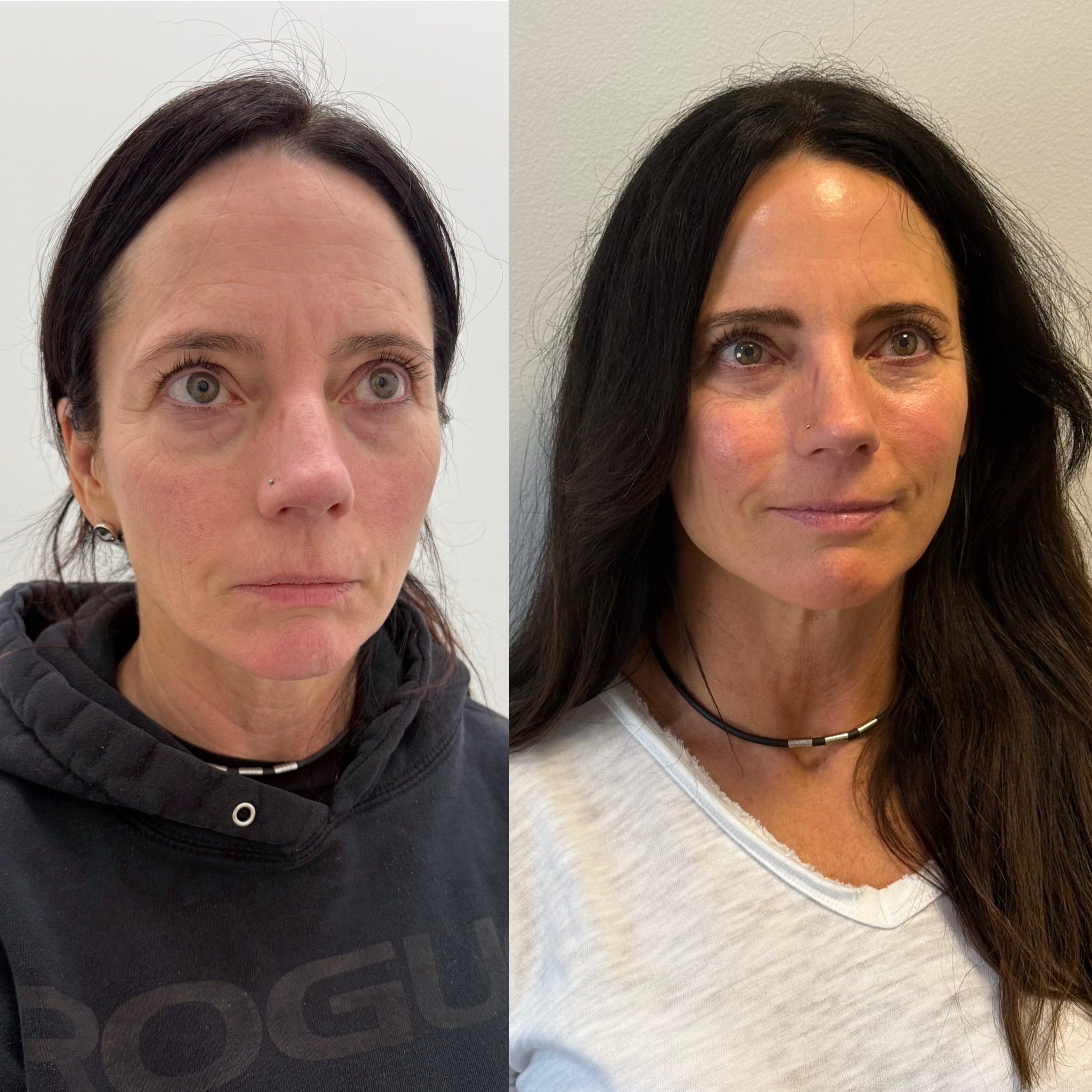 Before and After Image: Sculptra - right-front-oblique