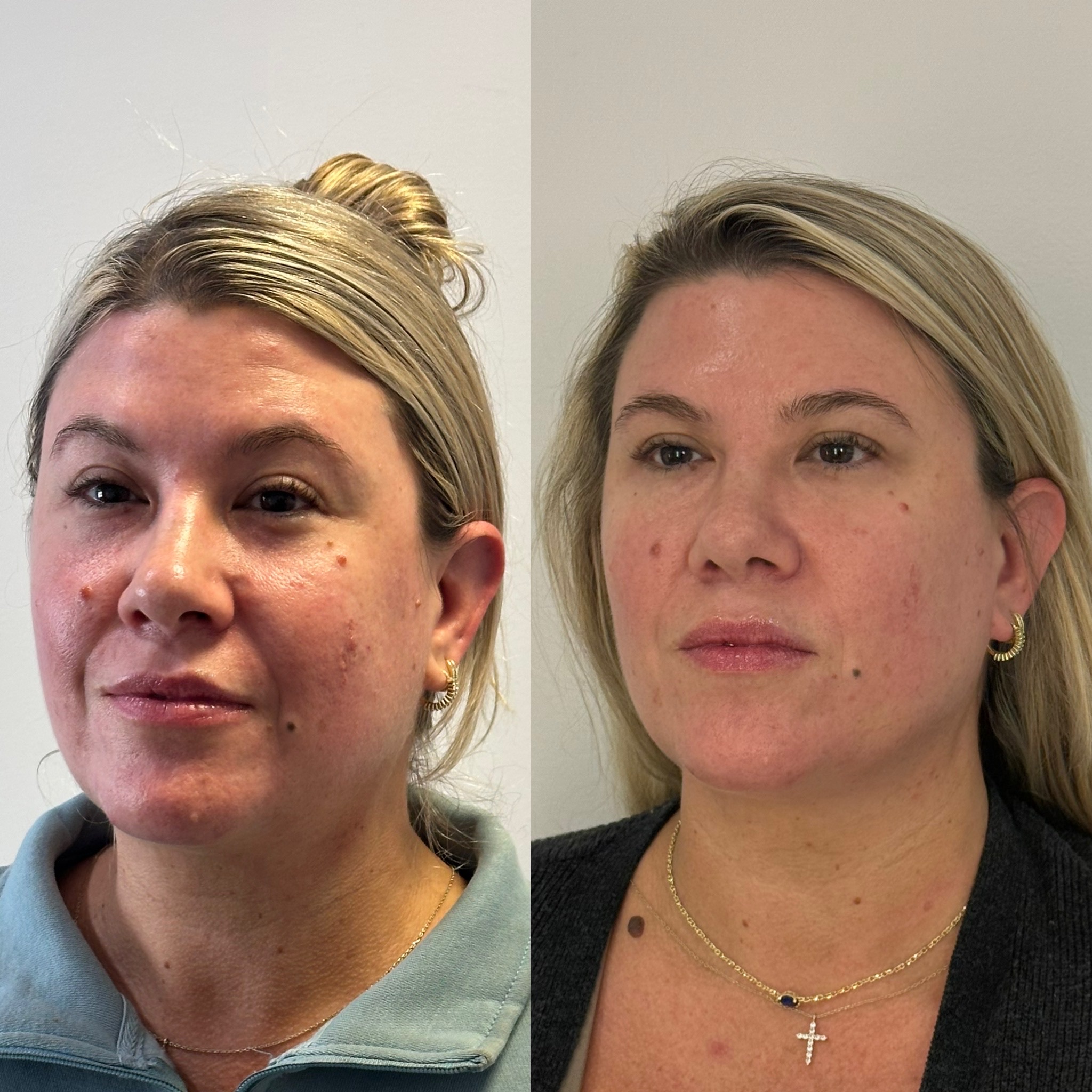 Before and After Image: Full Face Botox - left-front-oblique