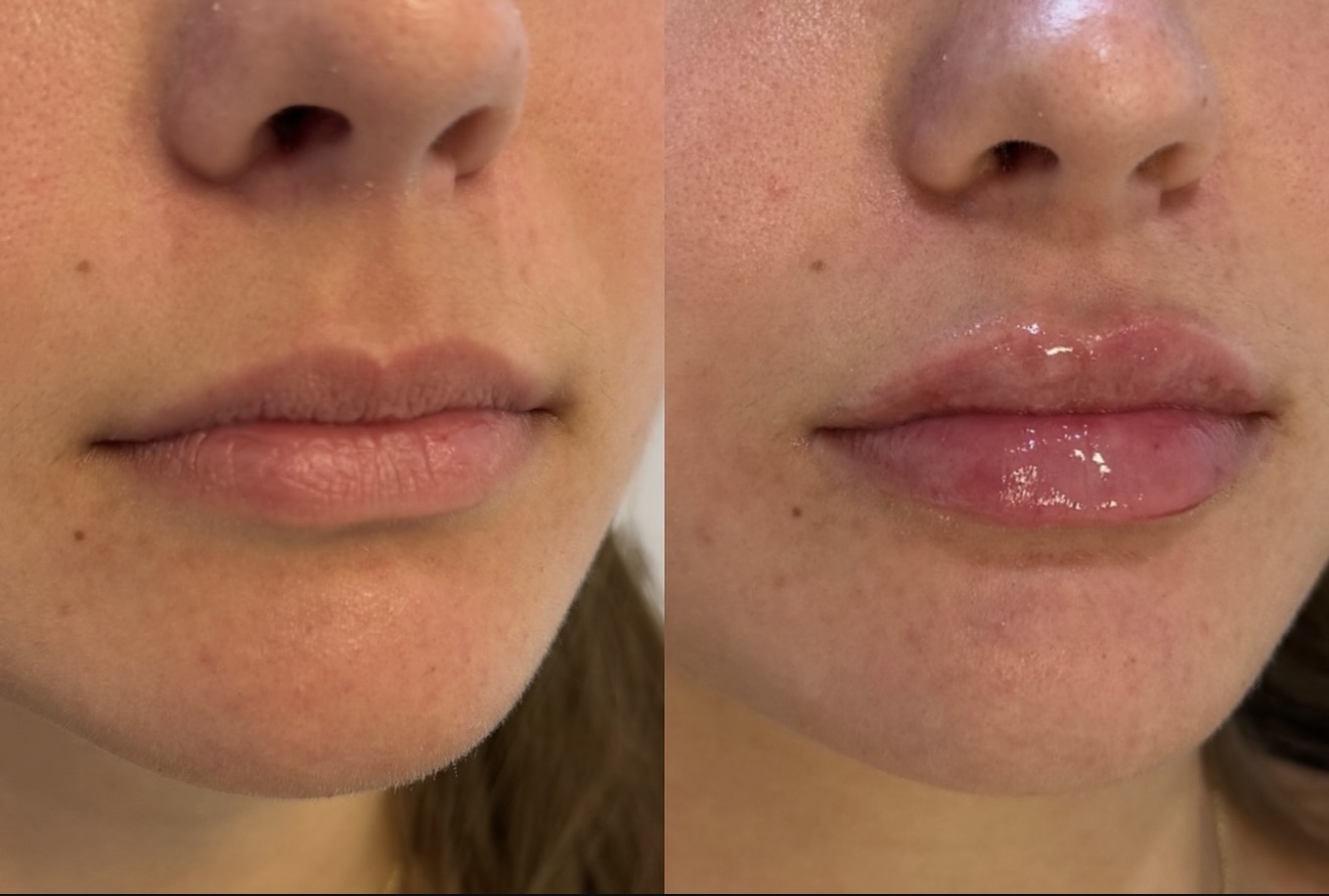 Before and After Image: Lip Filler - right-front-oblique
